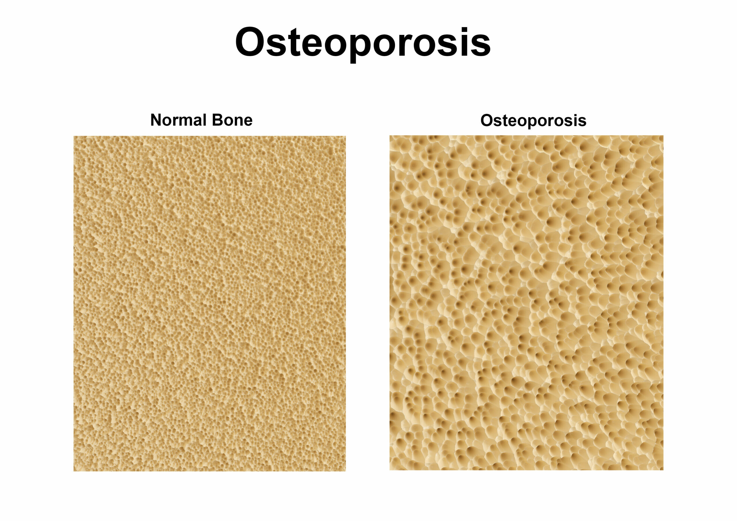 Osteoporosis and Hormones
